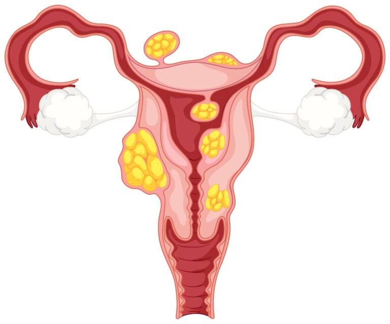 cervical cancer